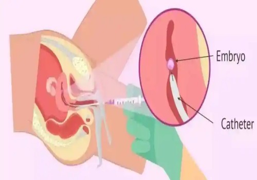 偶發(fā)還是遺傳？看看4號染色體三體異常現(xiàn)象的真正原因