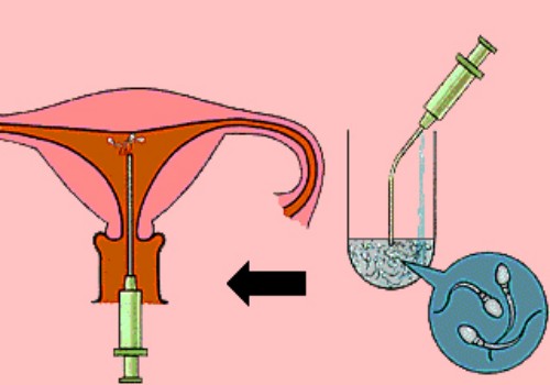 盤點試管嬰兒希愛力的正確使用方法，注意時間和劑量才是關(guān)鍵