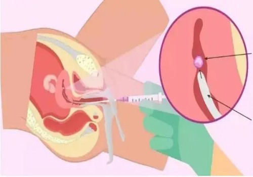 寧波三代試管助孕：產(chǎn)婦坐月子是42天還是30天？到底哪一個(gè)正確