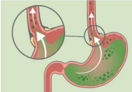 寧波供卵試管：做試管需要對精子怎么處理，需要預(yù)洗嗎